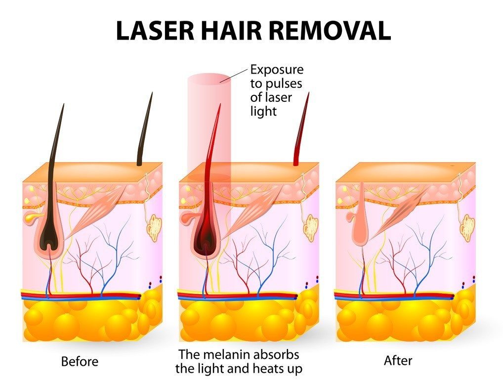 A diagram showing how laser hair removal works